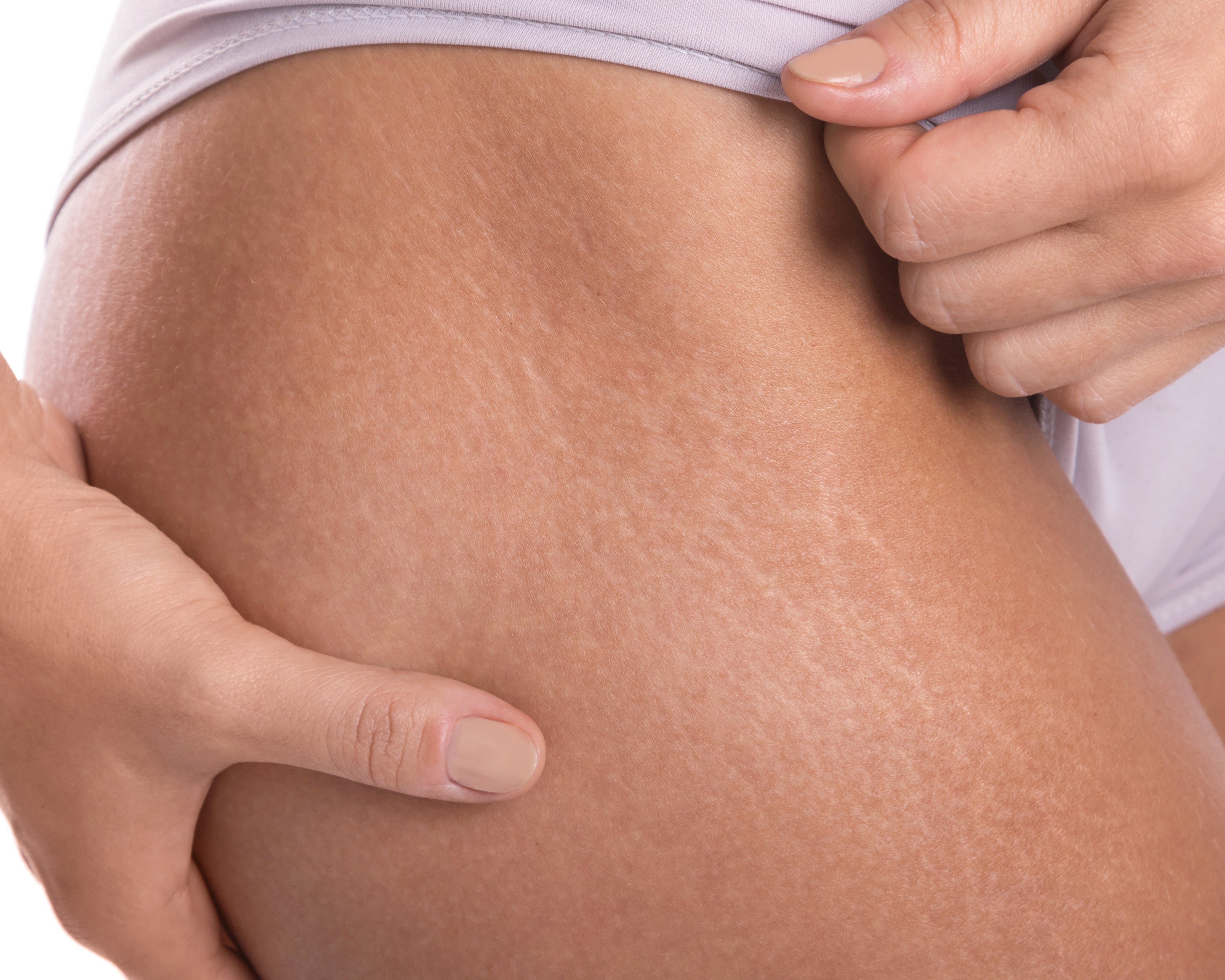 Why do stretch marks appear?