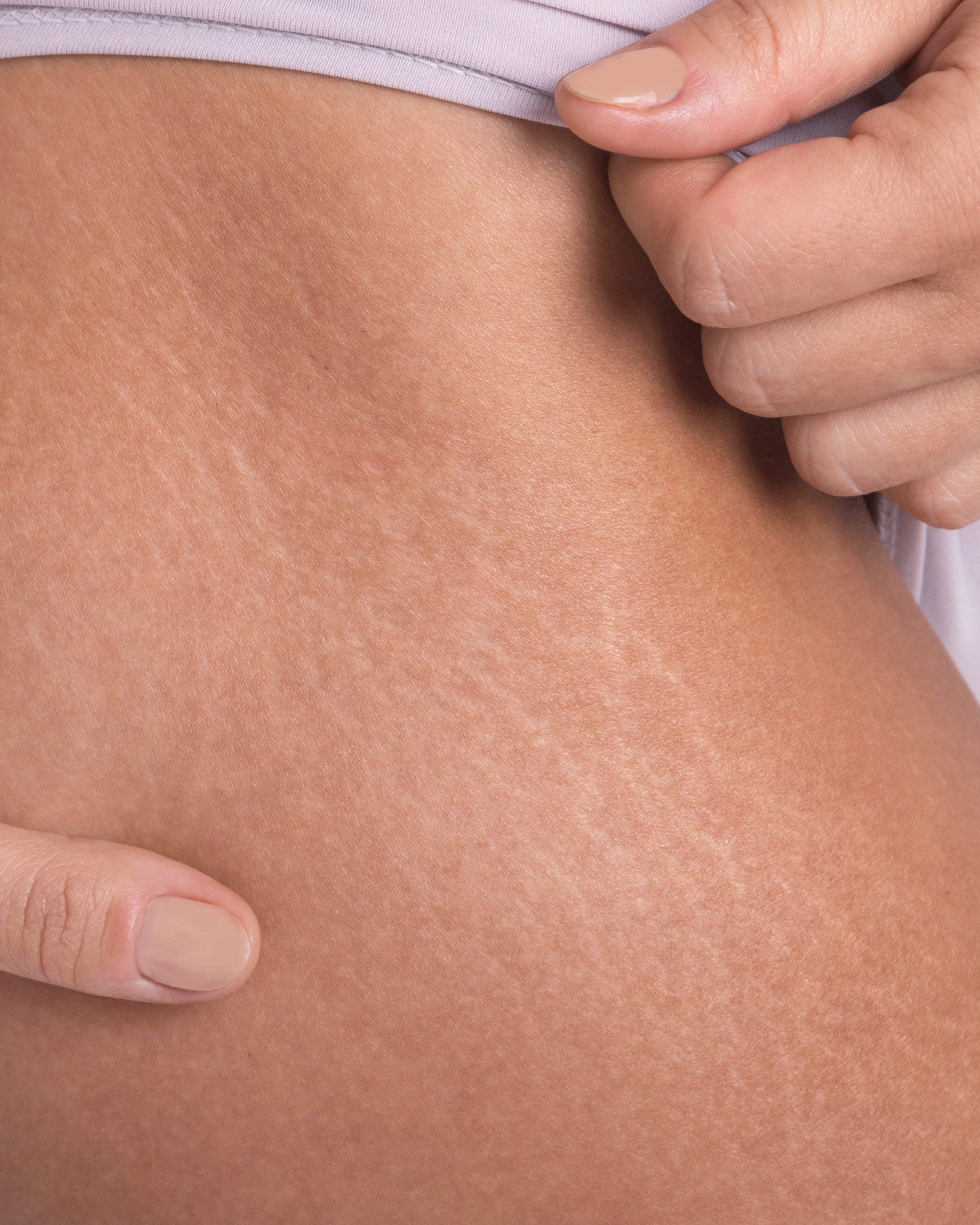 When stretch marks commonly develop